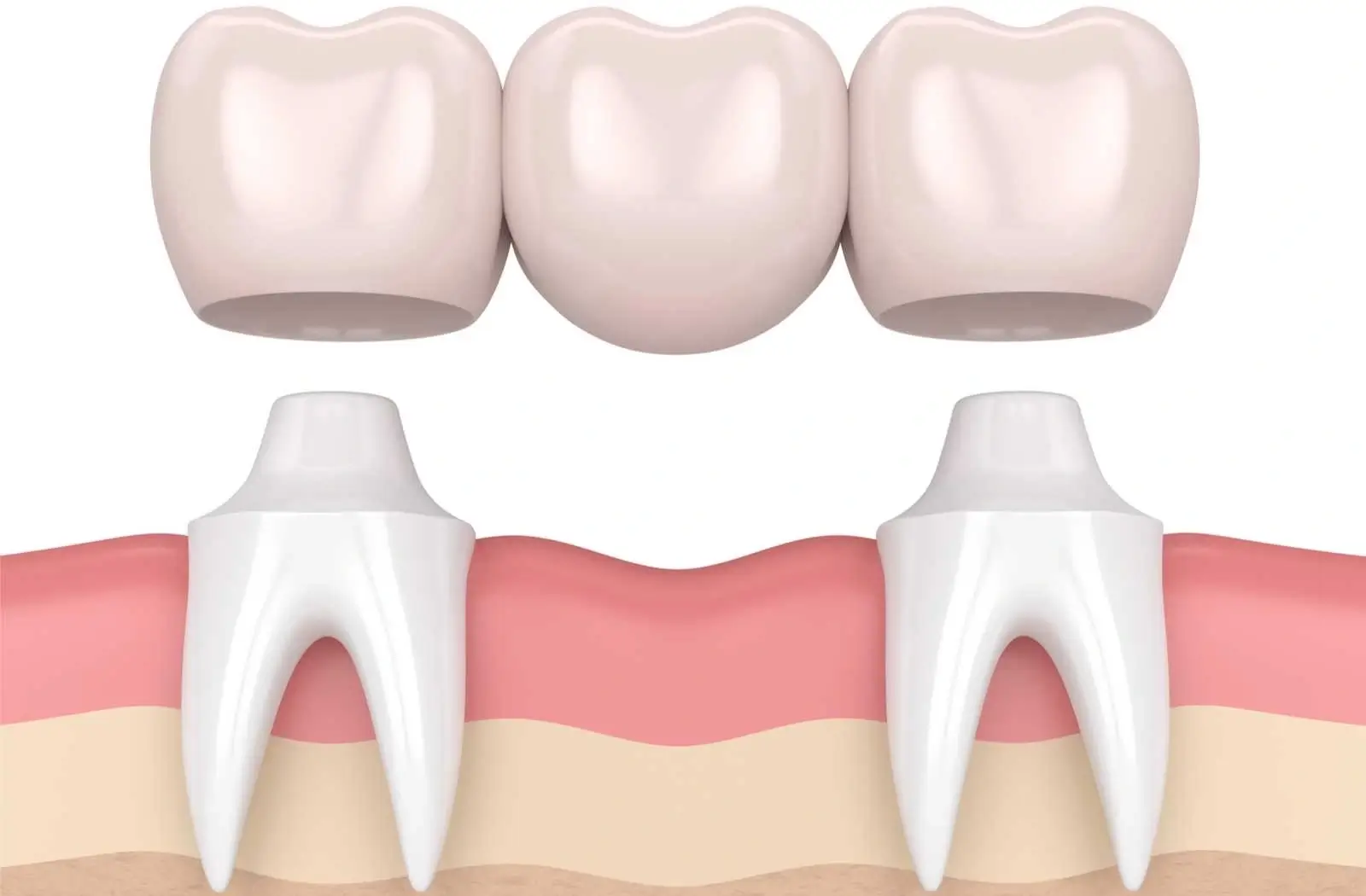Dental Bridges